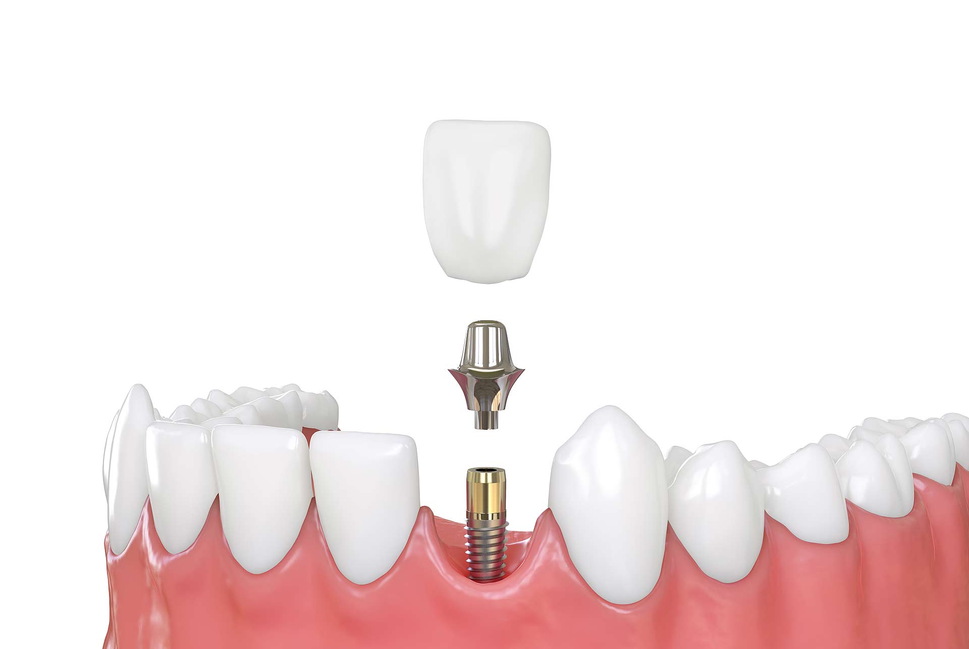 Dental Implants